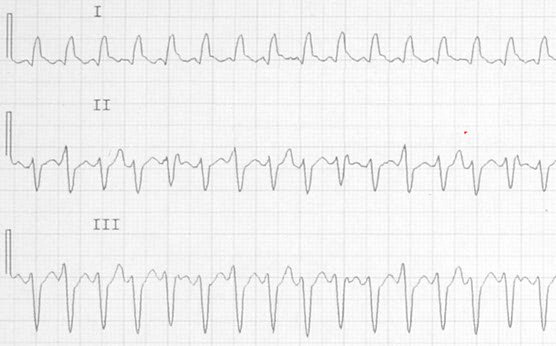 ECG - Ventricular Tachycardia